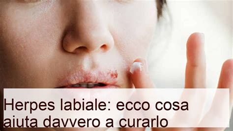 Herpes labiale: ecco cosa aiuta davvero a curarlo .